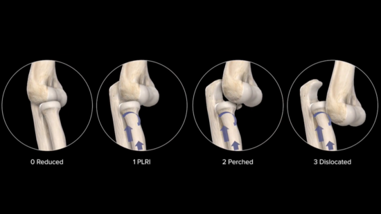 Lateral Ulnar Collateral Ligament (LUCL) Injuries : OrthoPedia