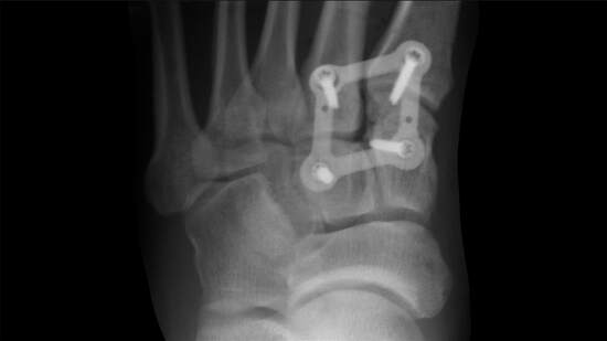 Lisfranc Complex Injuries: General Surgical Considerations : OrthoPedia