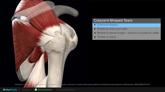 Posterior Rtc Biomechanics of the Shoulder With Posterosuperior Rotator Cuff Tears ...