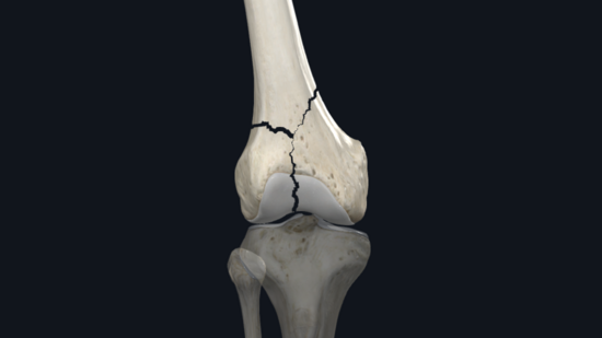 Distal Femur Fractures : OrthoPedia