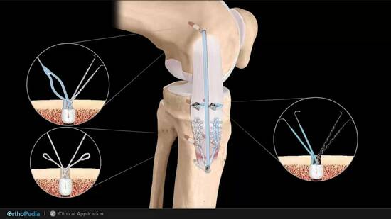 Medial Collateral Ligament Injuries: Distal MCL Repair Using Knee ...