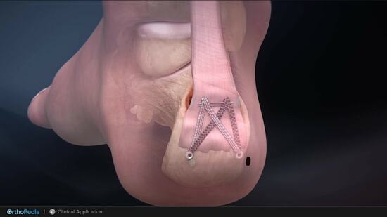 Insertional Achilles Tendinopathies: MIS FiberTak® Achilles SpeedBridge ...