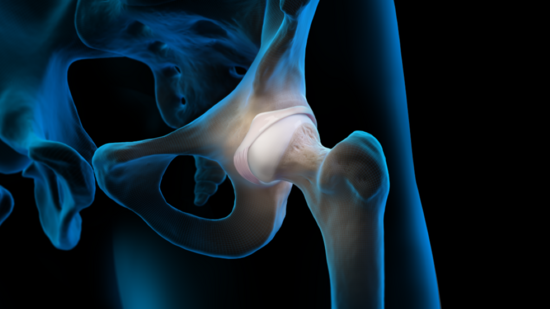 Hip Impingement : OrthoPedia Patient