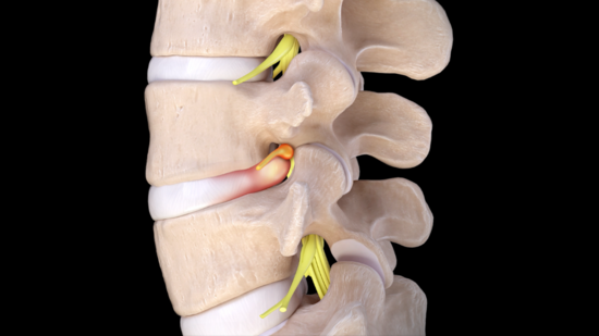 Disc Disease : OrthoPedia