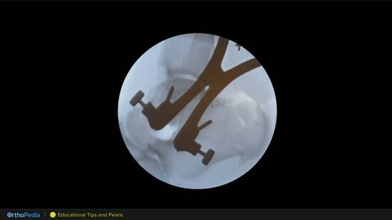 Dr. Murphy Demonstrates Tips and Pearls for Hindfoot and Ankle ...