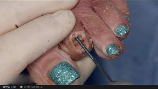 Lesser Toe Block Lesser Toe Pathologies: Surgical Technique Pearls When Using Snap-Off ...
