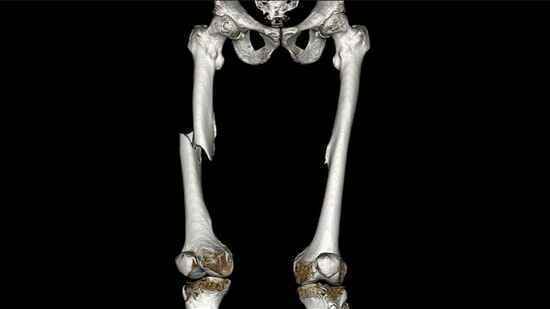 大腿骨骨折 : OrthoPedia Patient