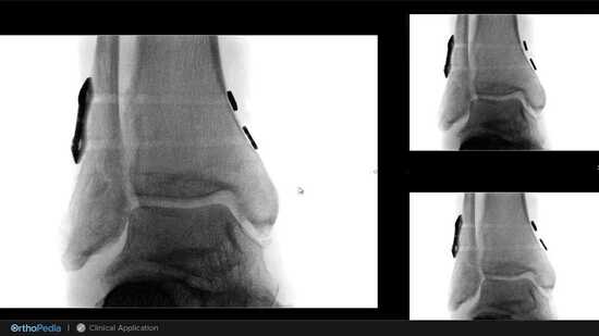 Ankle Syndesmosis: Dual Syndesmosis TightRope® Implant System : OrthoPedia