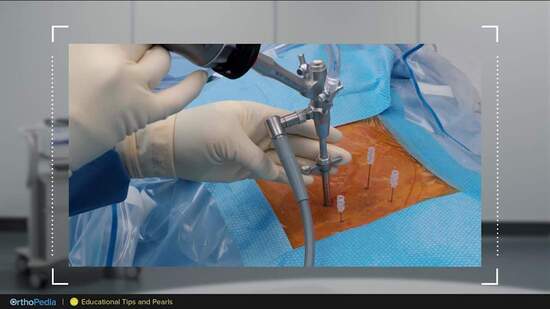 Dr. Yeung Demonstrates Tips and Pearls for Endoscopic Spine Surgery ...