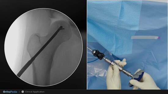 Femoral Head Avascular Necrosis: Core Decompression With the AVN ...