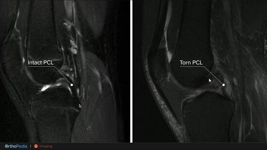 Pcl Injuries Evaluation of Posterior Cruciate Ligament (PCL) Injuries : OrthoPedia