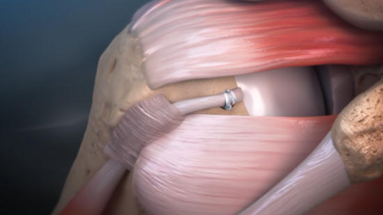 Biceps Tendinitis: Arthroscopic Repair Technique at the Top of the ...