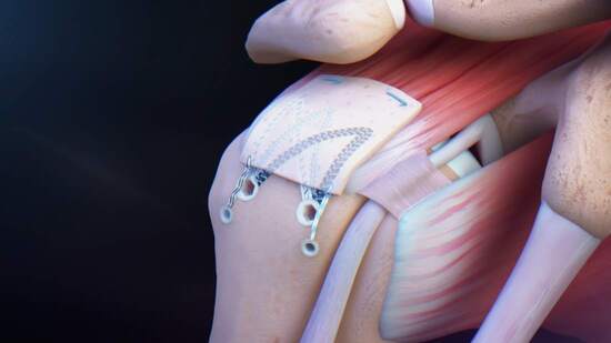 Rotator Cuff Tears: Augmentation of a Rotator Cuff Repair With a Graft ...