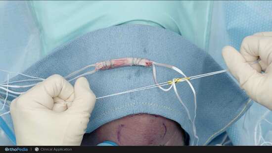 Fiber Tag Anterior Cruciate Ligament (ACL) Injuries: All-Inside Quad ACL ...